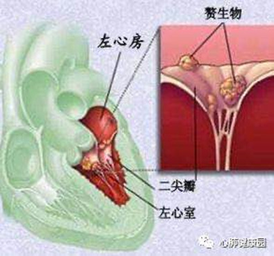 炎 膜 内 細菌 心 性